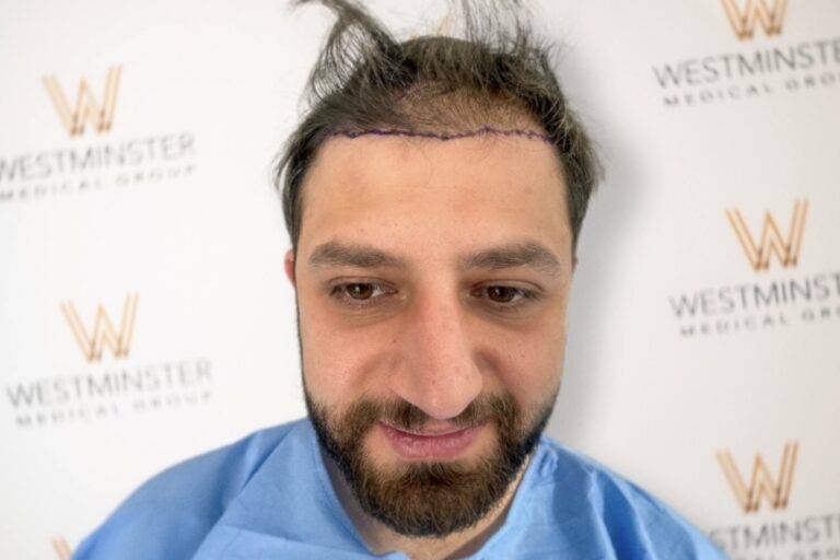 A man in medical scrubs with marked hairlines and several thin hair implant grafts, smiling slightly, in front of a backdrop with the Westminster Medical Group logo.