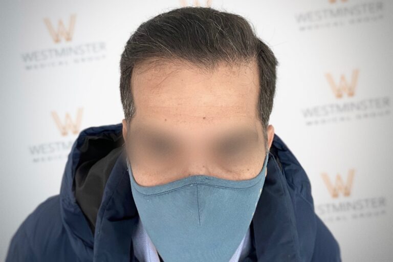 Hair Transplant Results 26