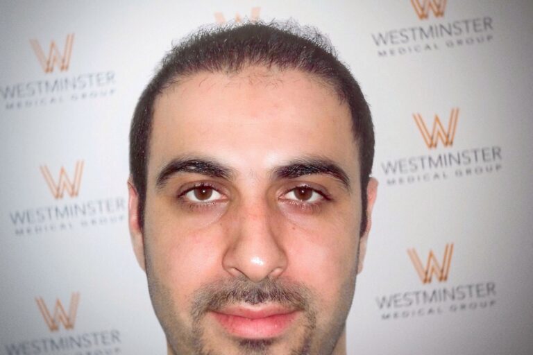 Hair Transplant Results 42