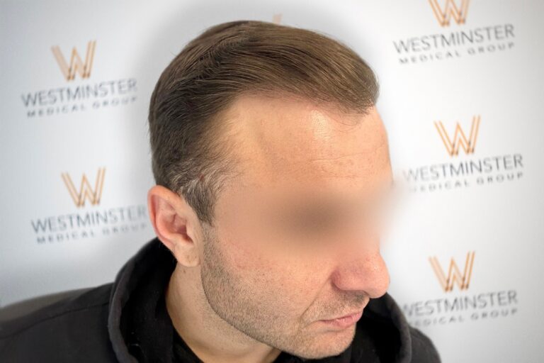 Hair Transplant Results 36