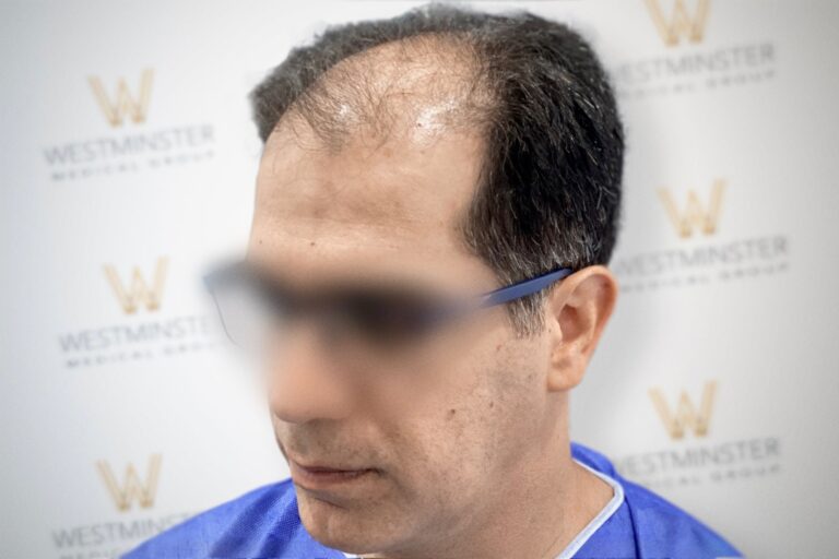 Hair Transplant Results 27