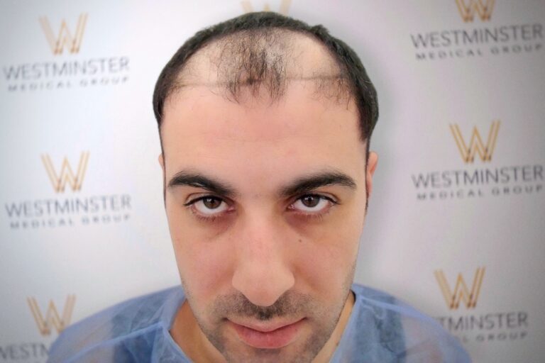 Hair Transplant Results 41
