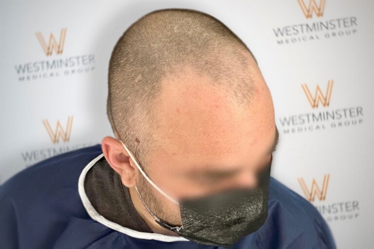 Hair Transplant Results 35