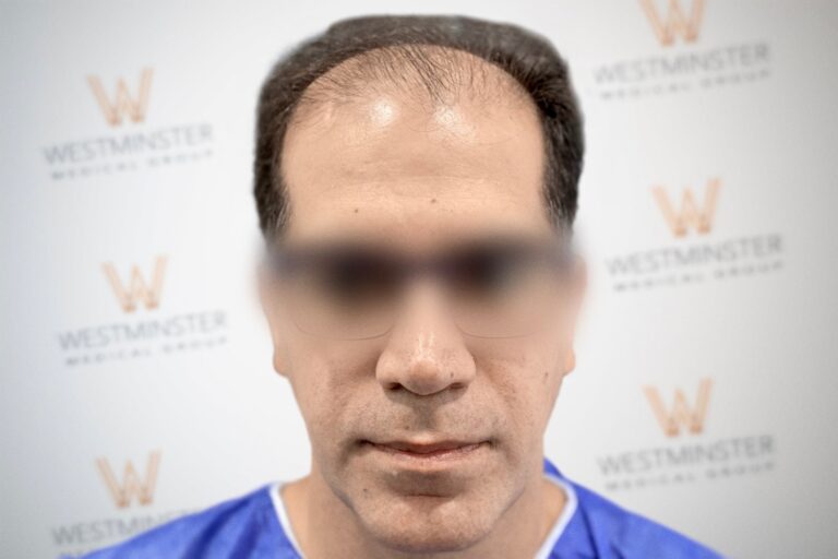 Hair Transplant Results 25