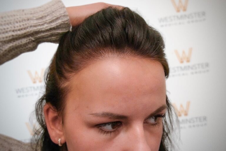Hair Transplant Results 22