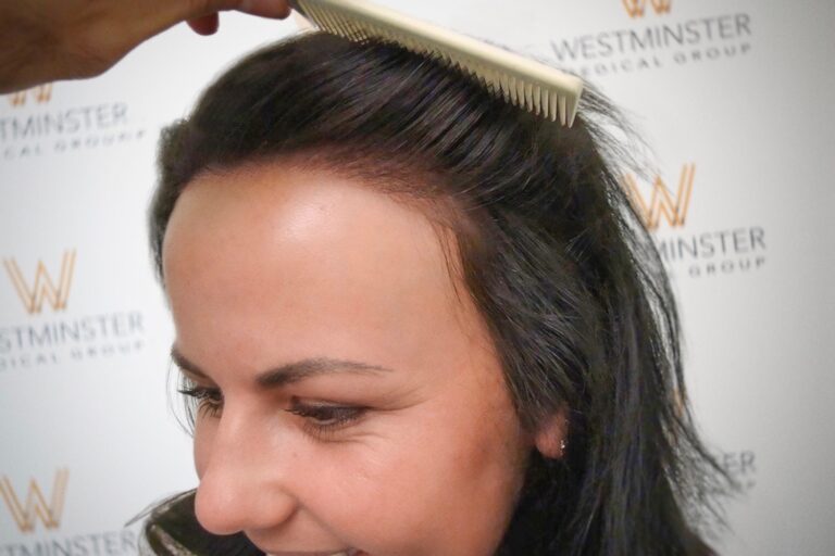 Hair Transplant Results 24