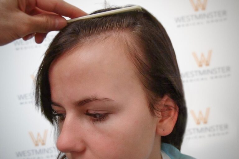 Hair Transplant Results 23