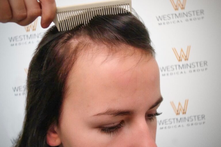 Hair Transplant Results 21
