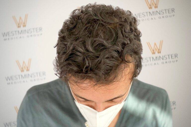 Hair Transplant Results 20