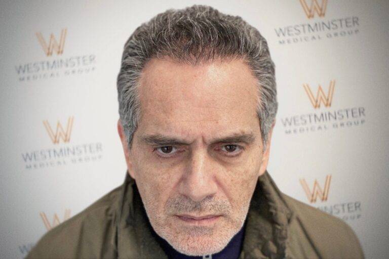 Hair Transplant Results 10