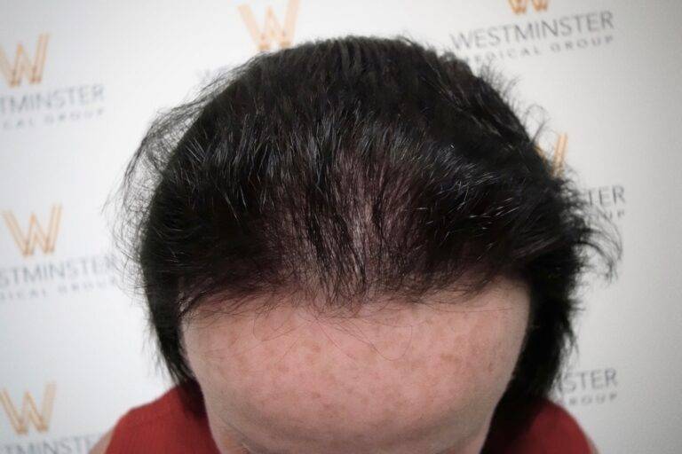 Hair Transplant Results 38