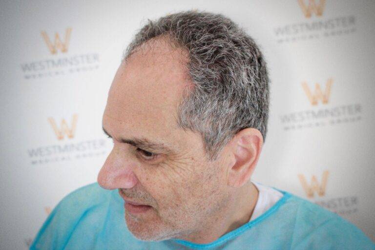 Hair Transplant Results 11