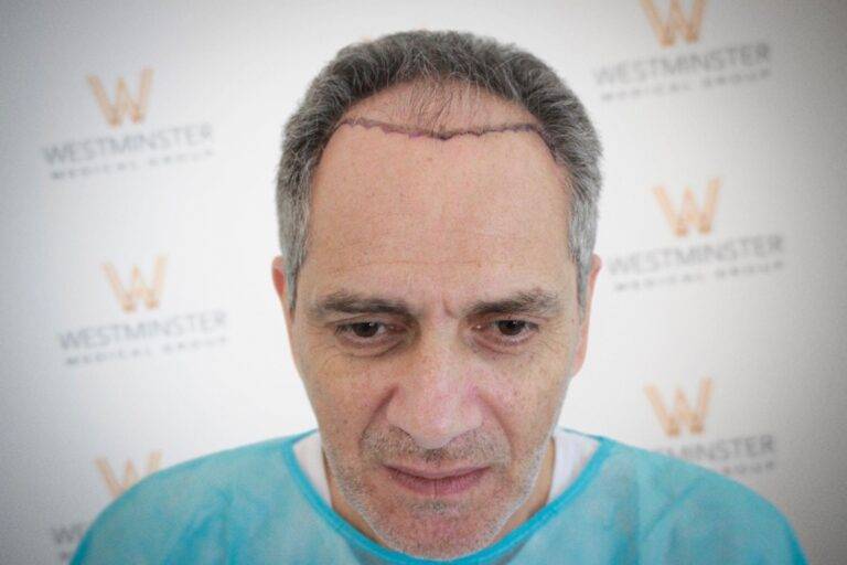 Hair Transplant Results 9