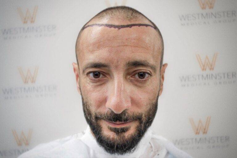 Hair Transplant Results 17