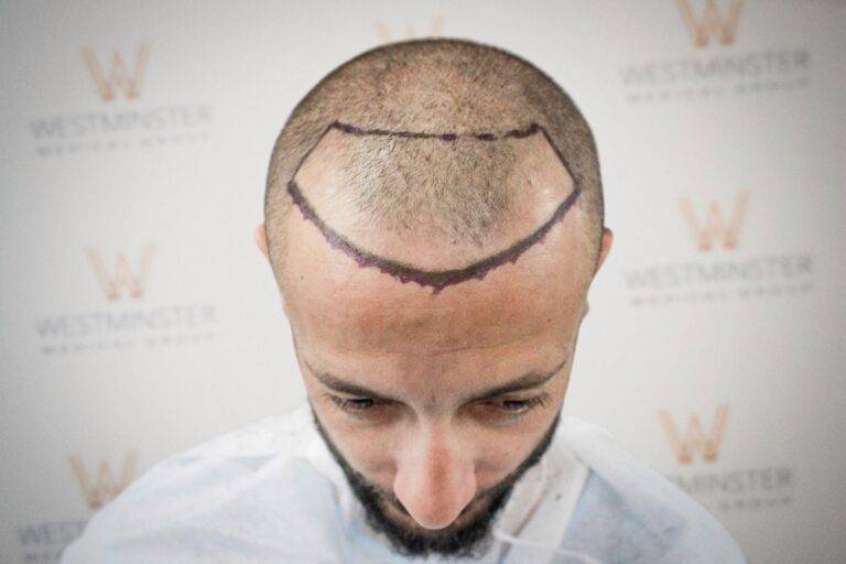 Hair Transplant Results 19