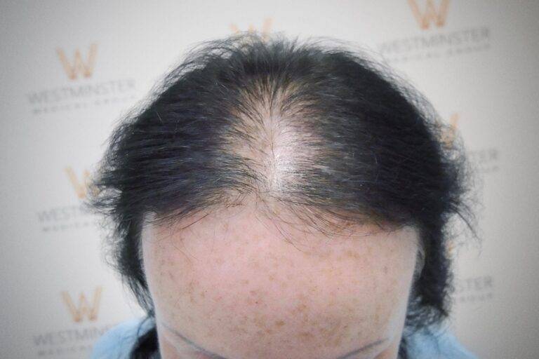 Hair Transplant Results 37