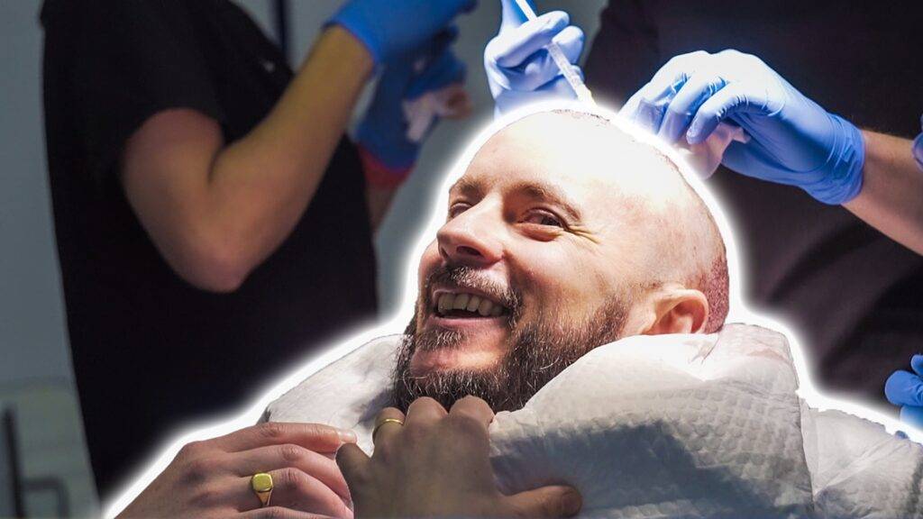 Hair Transplant Cost London new 1