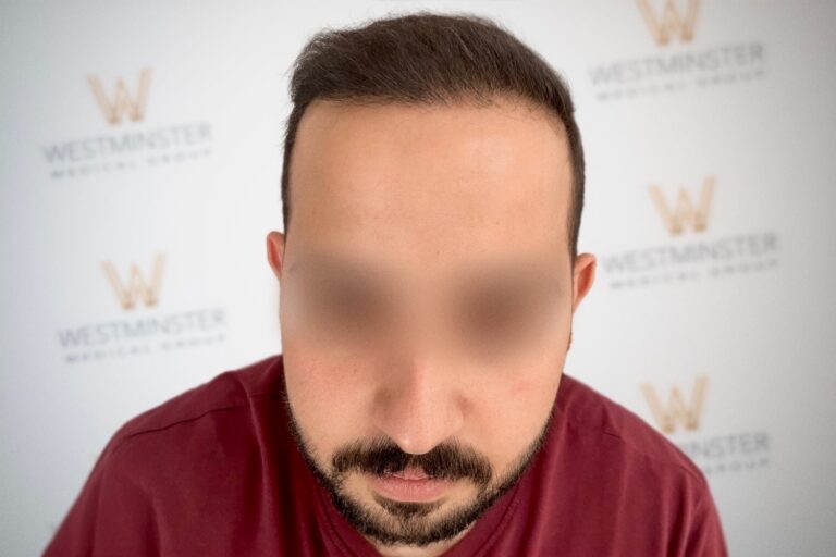 Hair Transplant Results 44