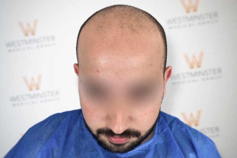 Hair Transplant Results 43