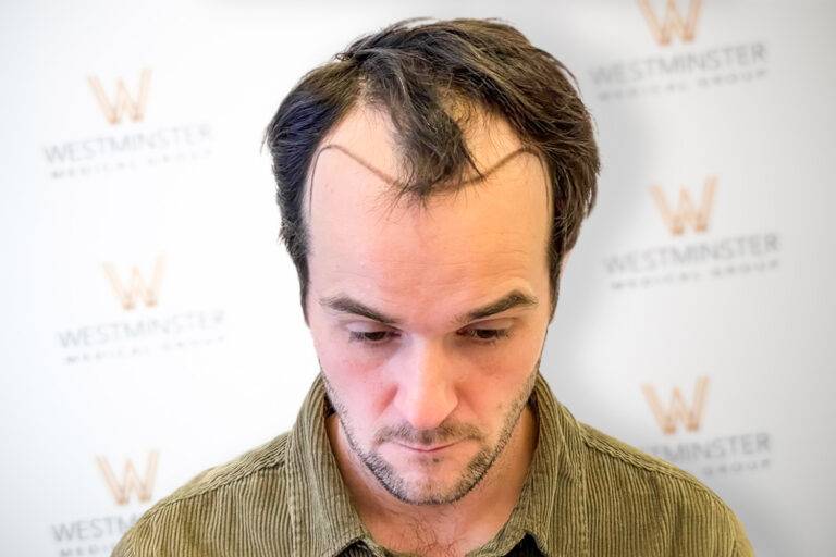 Hair Transplant Results 1