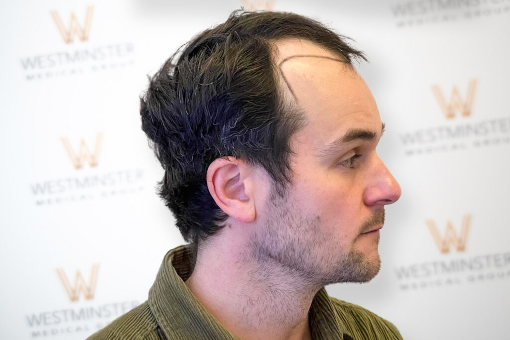 How Much Does a Hair Transplant Cost in the UK in 2026? Full Price Breakdown 4