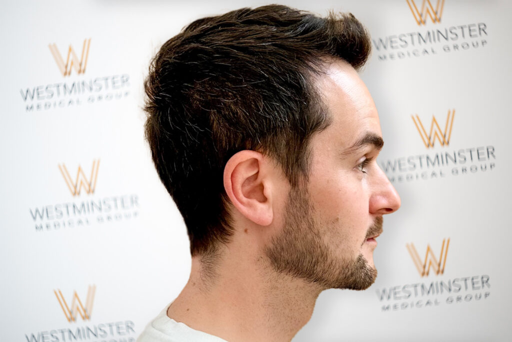 How Much Does a Hair Transplant Cost in the UK in 2026? Full Price Breakdown 5