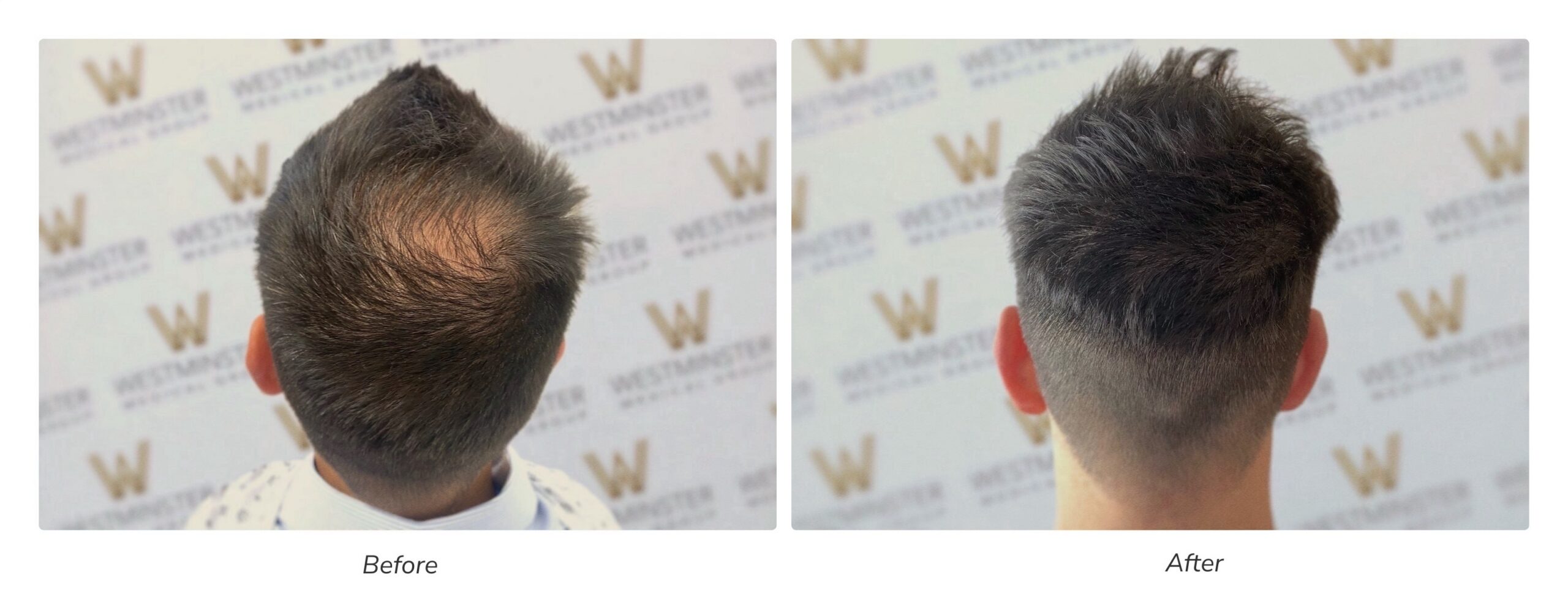 Hair Transplant for Crown Balding: Best Techniques and Expected Results in the UK 3