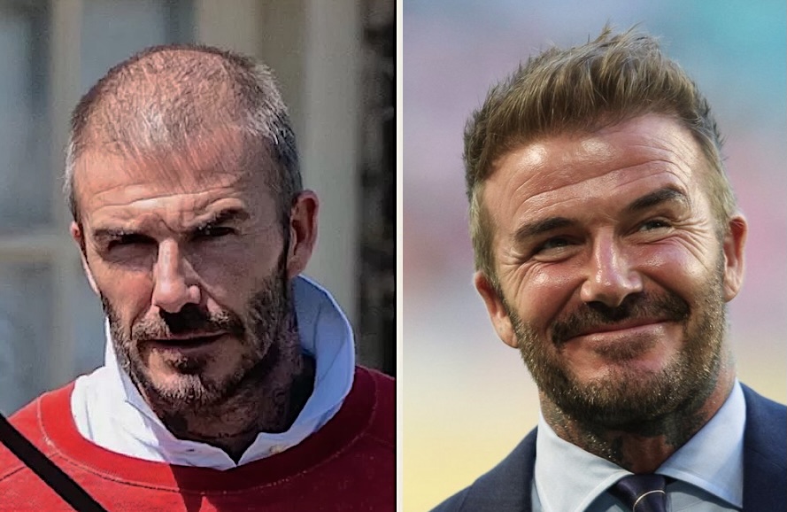 David Beckham Hair Transplant Result 6