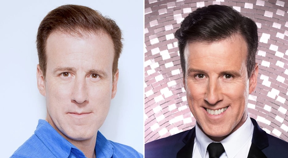 The "Anton Du Beke" Effect 1 The "Anton Du Beke" Effect 1