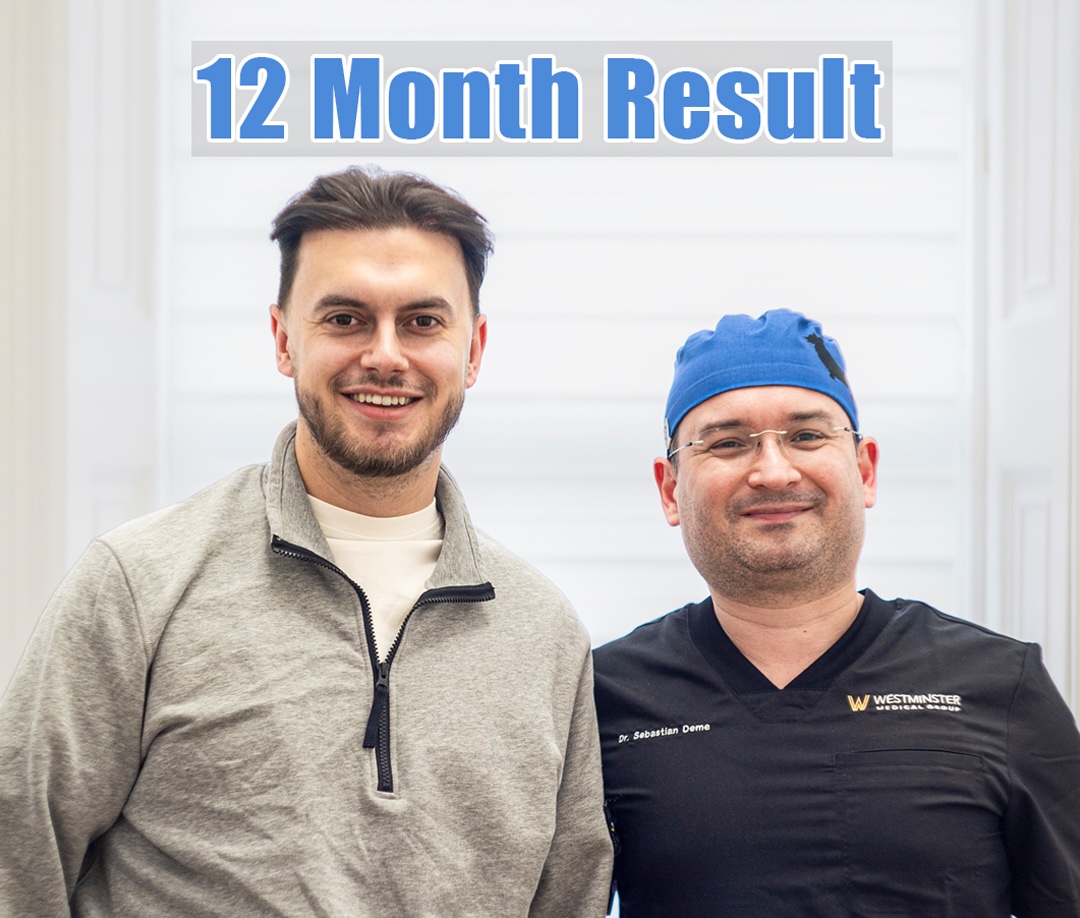 Best Age for a Hair Transplant: When Should You Get One in the UK? 1