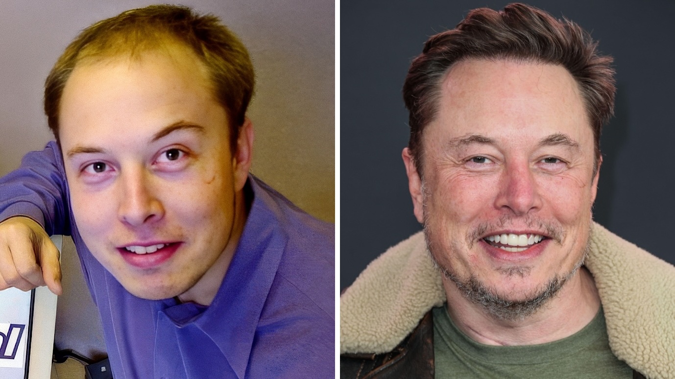 Elon Musk Hair Transplant 1