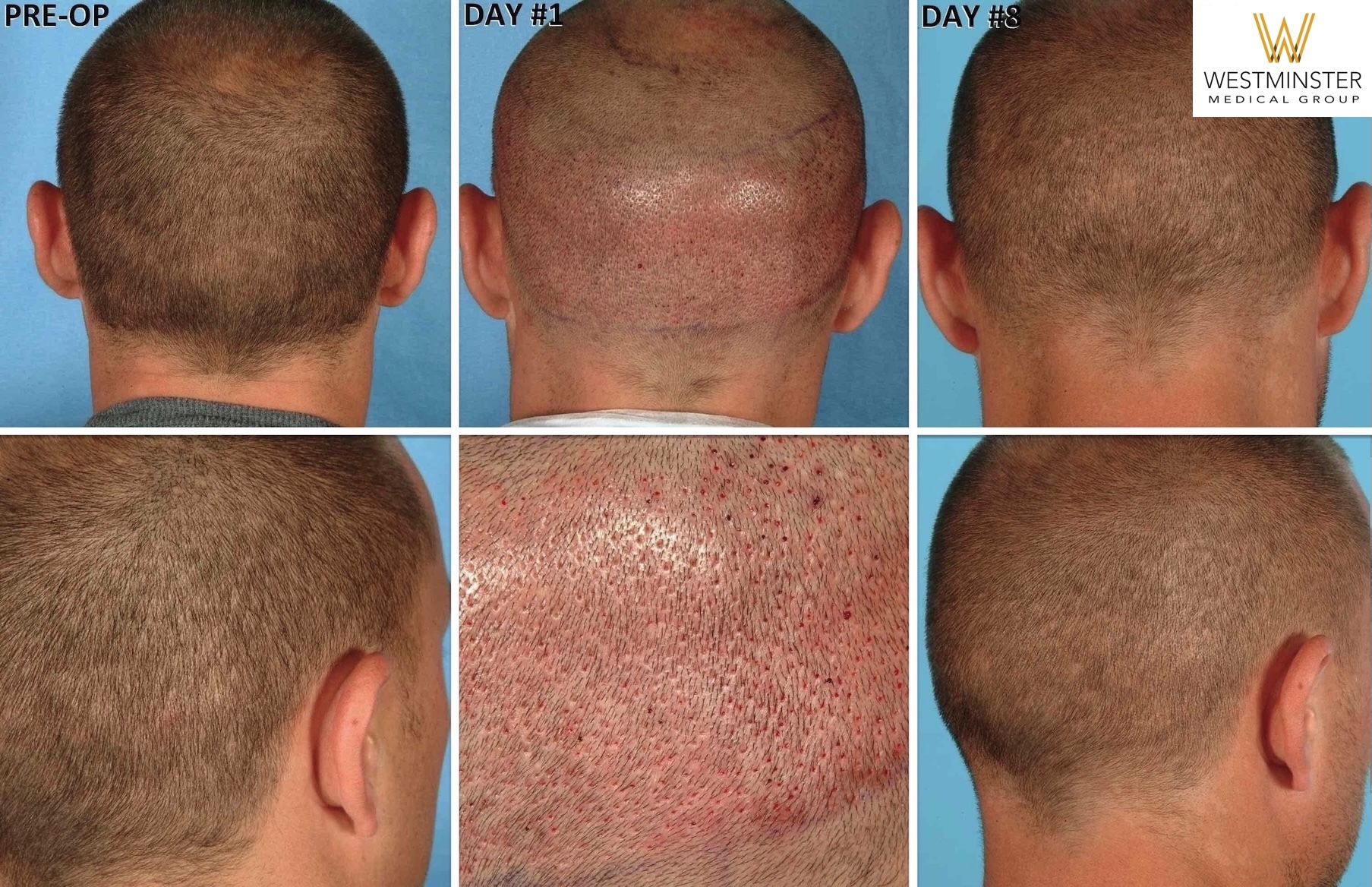 FUE vs FUT Hair Transplant: Which Method Is Best For UK Patients? 4