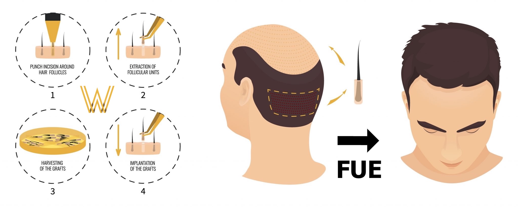 Hair Transplant for Crown Balding: Best Techniques and Expected Results in the UK 1