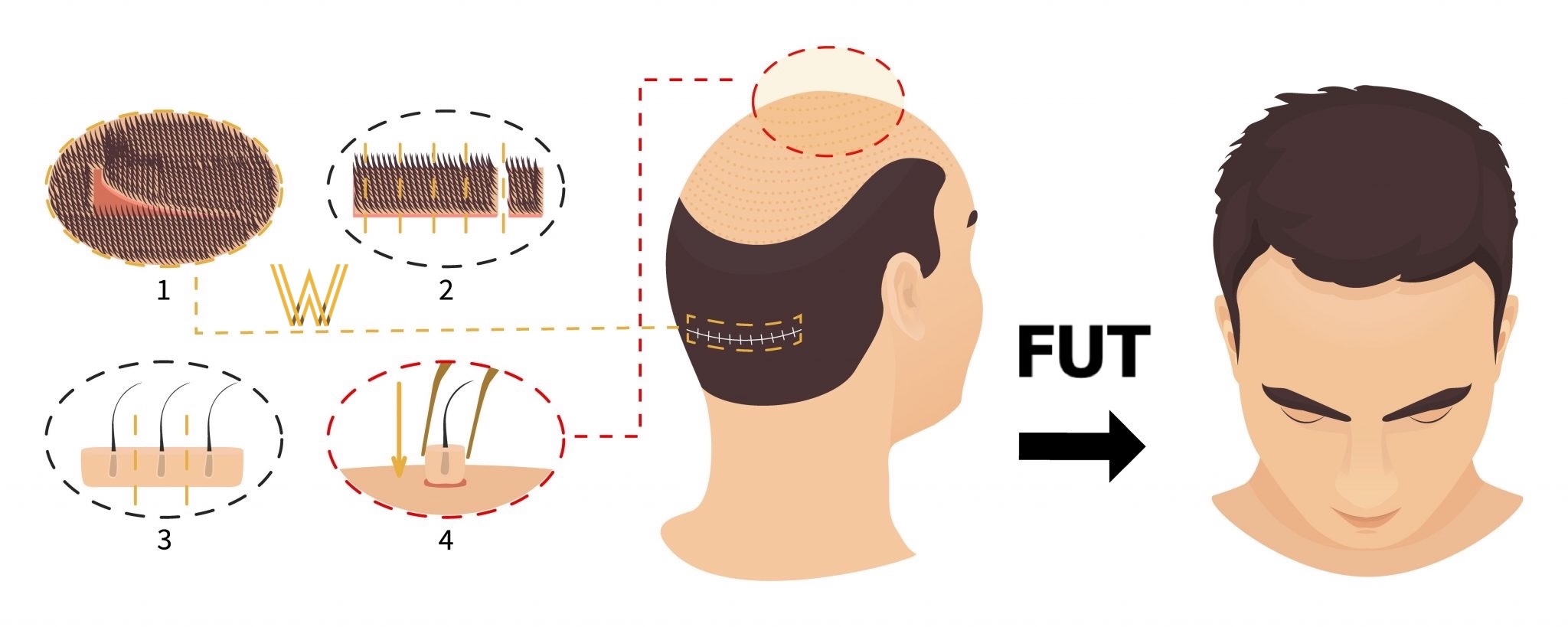 Hair Transplant for Crown Balding: Best Techniques and Expected Results in the UK 2