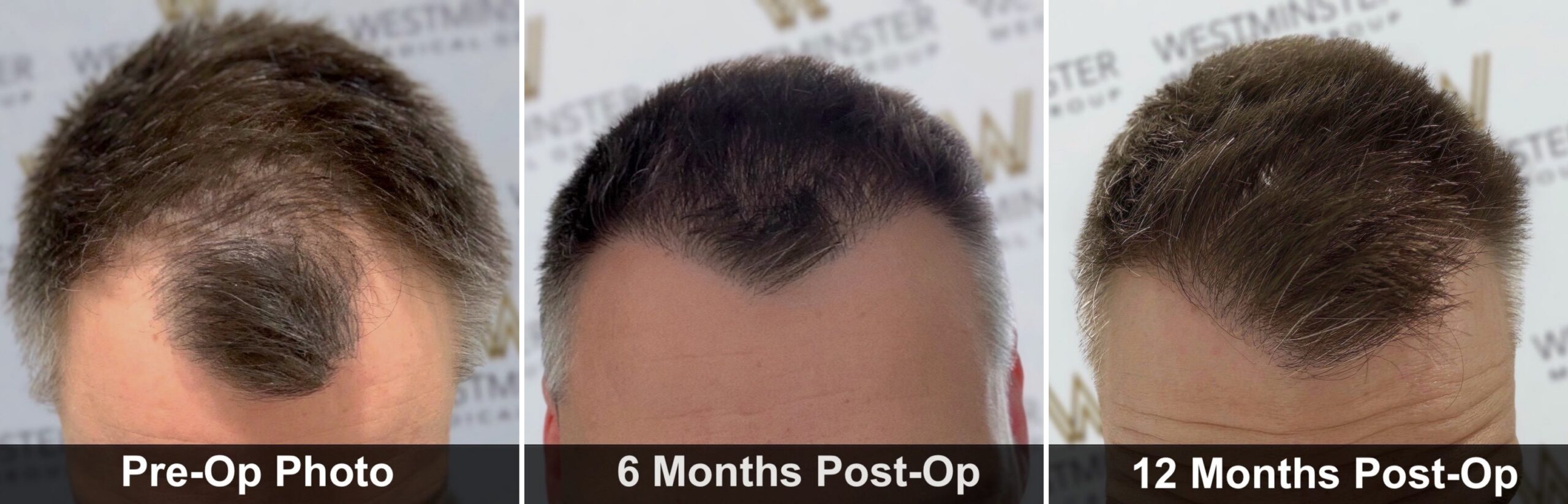 Hair Transplant for Receding Hairline: Techniques, Results & UK Costs 1