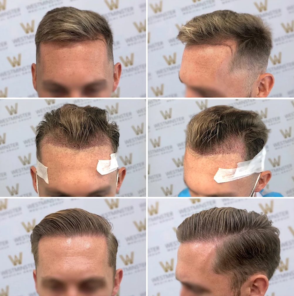 Hair Transplant Recovery Timeline: Week-by-Week Guide for UK Patients 1