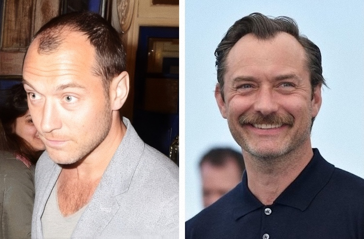 Jude Law Hair Transplant: The British Actor’s Subtle Transformation That Looks Completely Natural 1