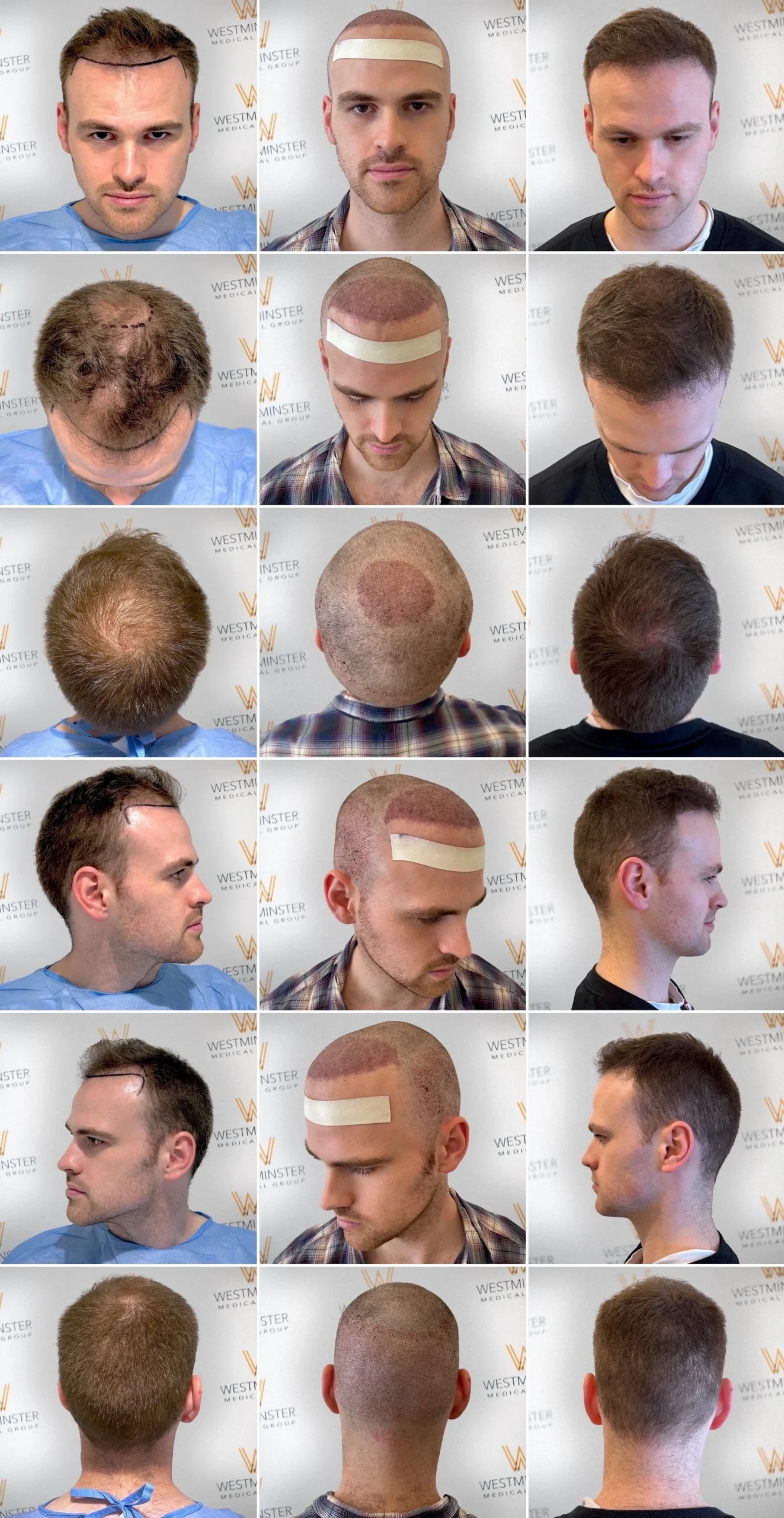 Superior WAW DUO FUE Hair Transplant 