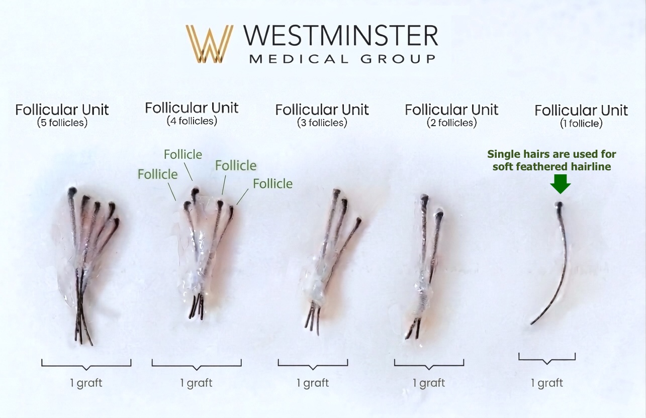WMG Soft Natural Hairline 2 Soft feathered natural hairline recreation using fine calibre hairs