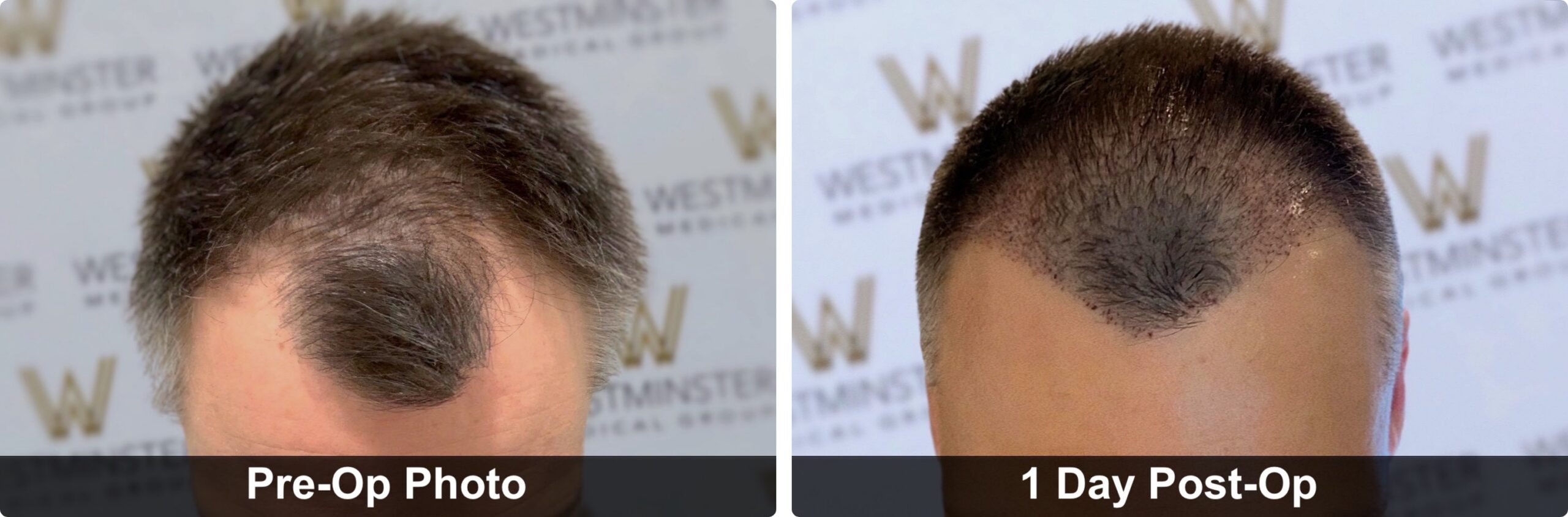 Hair Transplant Recovery Timeline: Week-by-Week Guide for UK Patients 3