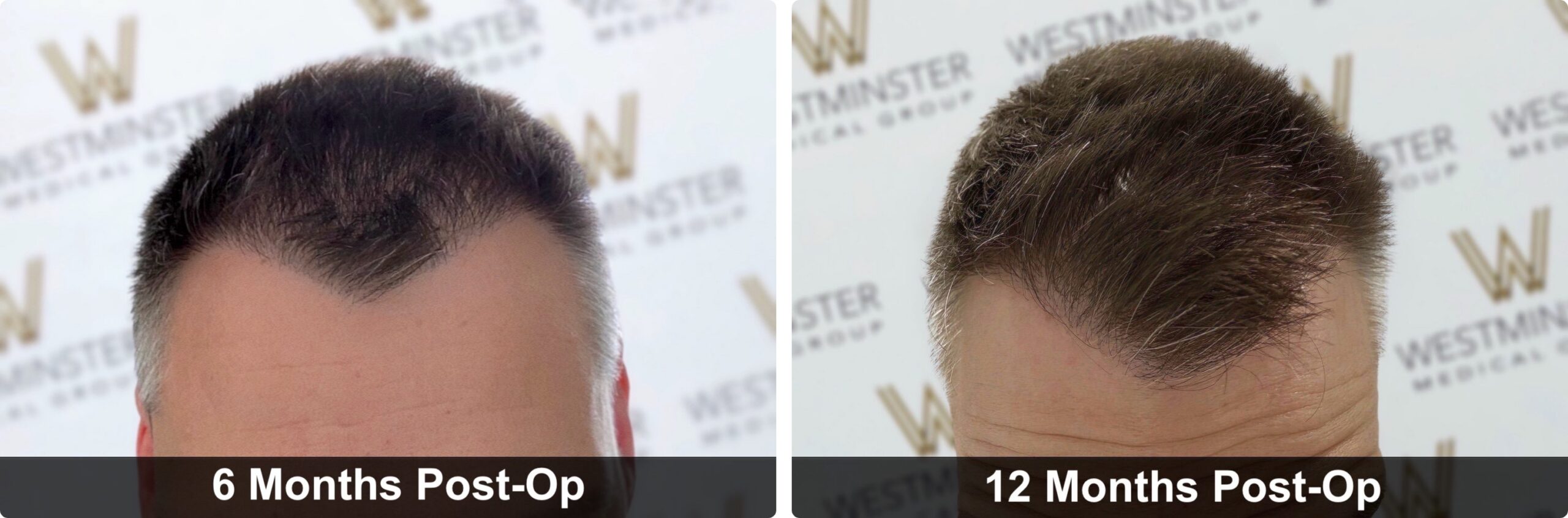 Hair Transplant Recovery Timeline: Week-by-Week Guide for UK Patients 4